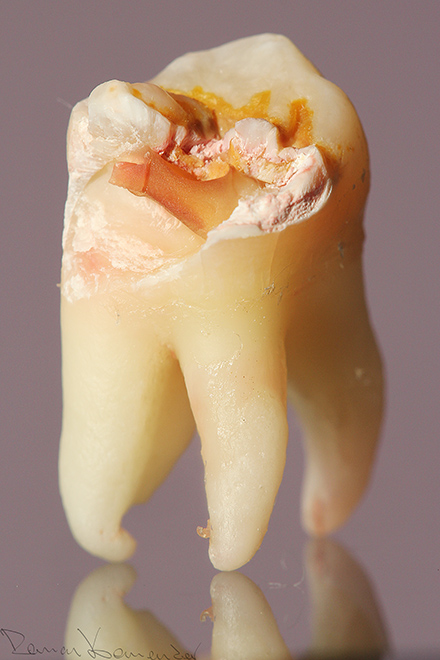 Zubní kaz (zub moudrosti)